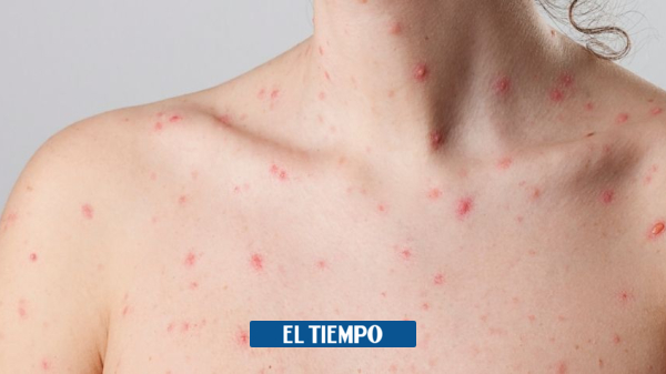 The authorities exclude the infection of a young man who showed symptoms of smallpox in Cauca