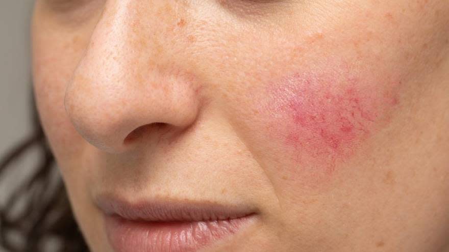 One new use of botulinum toxin is associated with adverse consequences or effects of rosacea